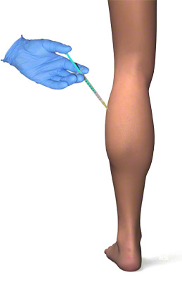 Reducción de pantorrillas con botox